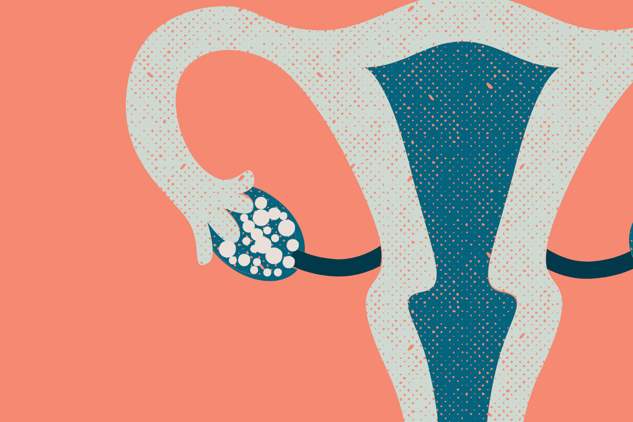 Polycystic Ovarian Syndrome (PCOS) and Fertility